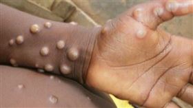 猴痘12倍速突變超詭譎　兒童首例讓專家緊張「代誌大條」　