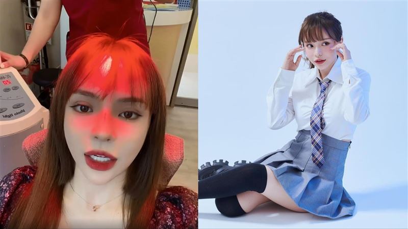 29歲女星認植髮：術後復原差很多！
