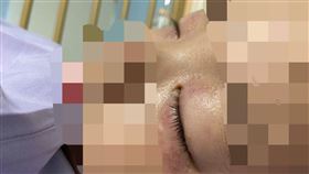 男童確診後為輕症，但卻感染帶狀皰疹，眼睛黑一圈。（圖／童綜合醫院提供）