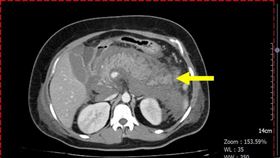 胰臟急性發炎，肚子悶痛連吐2天，40歲越南籍女子，陳鄭弘堯醫師 ，肝膽腸胃科(圖／中港澄清醫院提供)