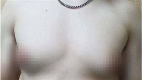 陳男罹患男性女乳症，即使減重胸前依舊相當明顯。（圖／光田綜合醫院提供）