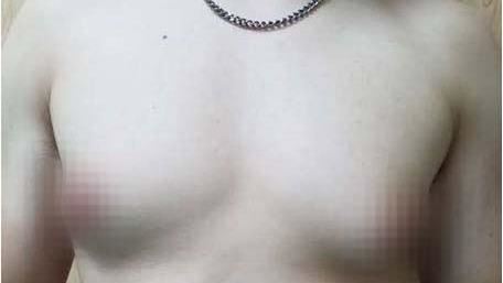 台灣也有類似案例,陳男罹患男性女乳症,即使減重胸前依舊相當明顯。(圖/光田綜合醫院提供)