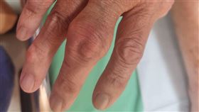 尿酸鹽結晶沉積在手指關節引發痛風，出現紅腫抽熱痛的症狀（圖／聯新醫院提供）