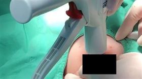 亞東醫院,小兒外科,夏肇聰,包皮,包皮環切手術（圖／亞東醫院提供）