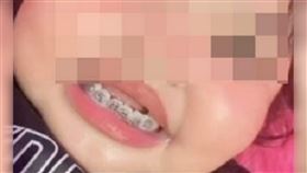 牙套,媽媽,抖音