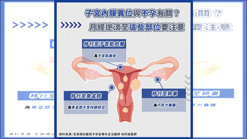 經痛劇烈　恐為子宮內膜異位前兆