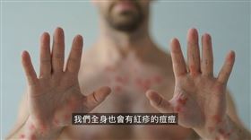 翻攝自童嵩珍老師談猴痘影片