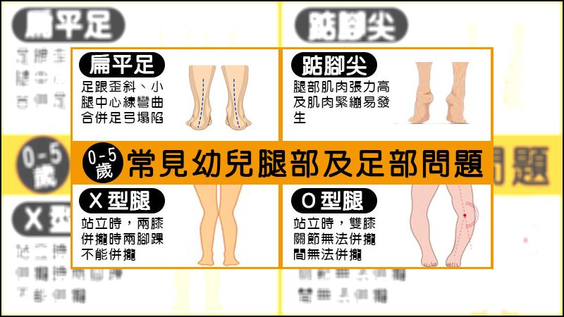 小孩到底是不是扁平足　專家帶你看