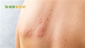 年老與免疫缺陷是帶狀疱疹最重要的危險因素，50歲以上發生率急遽上升，隨著年紀越長，發生機率越高。