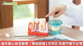 名家專用／傳統植牙治療時程長，患者需經歷多次手術，且尚未裝上假牙期間，缺牙問題會一直存在，而即拔即植正療程則能化解上述狀況。(勿用)