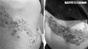  75歲老翁與30歲年輕老闆罹患帶狀皰疹。（施勝桓醫師提供）