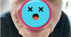 天花,病毒,梅毒,鼻子,猴痘,德國