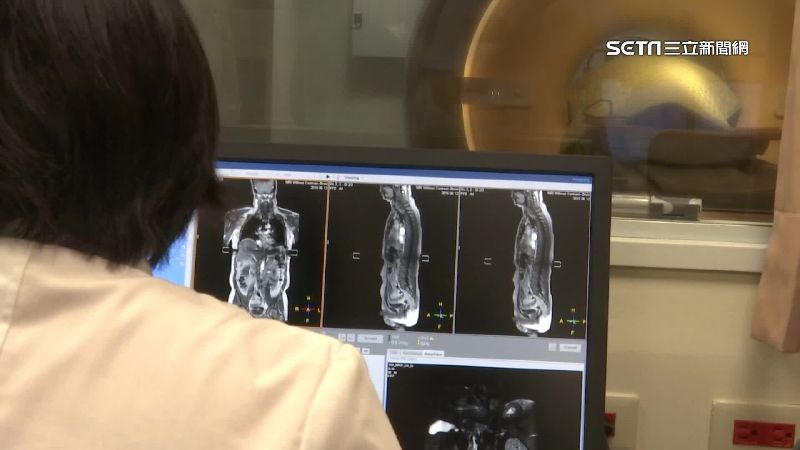 腸癌4警訊！中3個　罹癌風險近5成