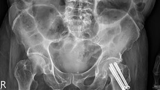 骨質疏鬆恐奪命！藥物治療有解方