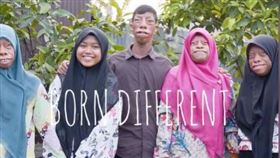 怪病　特雷徹•柯林斯綜合症　（圖／翻攝自Born Different臉書）
