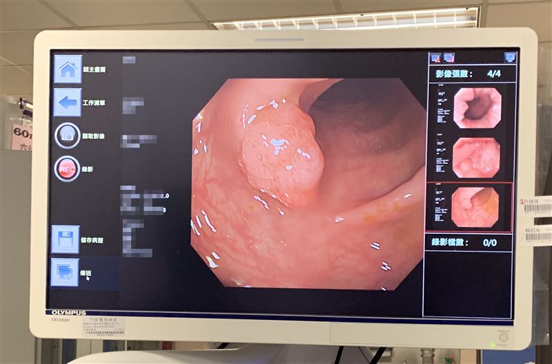胃腸肝膽科名醫蕭敦仁提醒，無痛麻醉「並非人人適合」！若屬於7大高風險族群，必須經過麻醉科醫師嚴格評估（示意圖／門諾醫院提供）