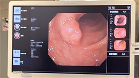 大腸鏡/大腸息肉(門諾醫院提供)