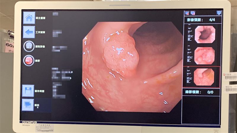 大腸癌6危險因子　這種常見藥物上榜