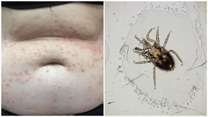 4個陌生人癢疹接連爆發　凶手都是它