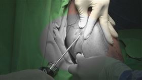 靜脈曲張個案。（圖／花蓮慈濟醫院提供）