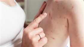 皮膚癌,濕疹,台灣,蔡逸姍,T細胞淋巴癌（示意圖／pixabay）