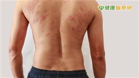 皮膚Ｔ細胞淋巴瘤發生原因不明，目前也未能找出好發族群。其中最常見的皮膚淋巴瘤是「蕈狀肉芽腫」，佔了60%，好發年齡為55至60歲。