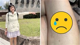 唐玲大腿嚴重過敏。（圖／翻攝自唐玲臉書）