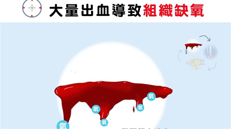 外傷恐2分鐘歿！醫曝「死亡金三角」