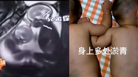  雙胞胎肚裡打架 出生都瘀青 （圖／翻攝自微博）