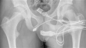 陰莖,USB傳輸線,手術