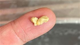 扁桃腺結石。爆廢公社