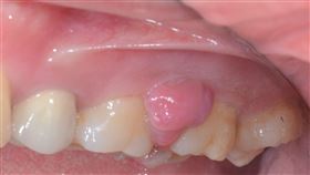 0911牙齦瘤