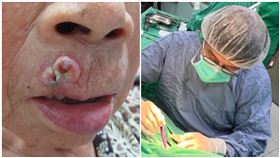 唇癌（南投醫院提供）