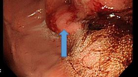 食道癌,腫瘤,胃食道逆流,（圖／新竹臺大分院提供）