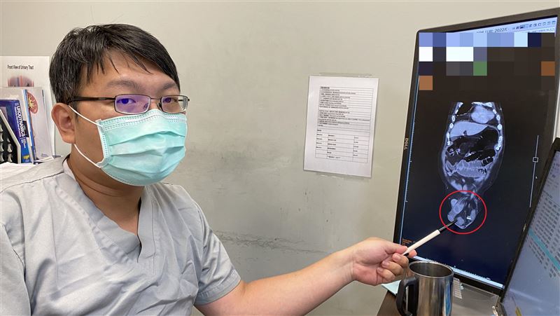 疝氣拖3年　代價「一段腸子」沒了