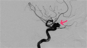 安南醫院,神經外科,張哲肇,頭痛,腦動脈瘤
圖／安南醫院提供