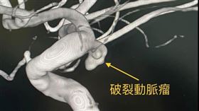 動脈瘤，前哨型頭痛，腦部血管MR健檢，(圖／翻攝自陳啟仁醫師臉書)