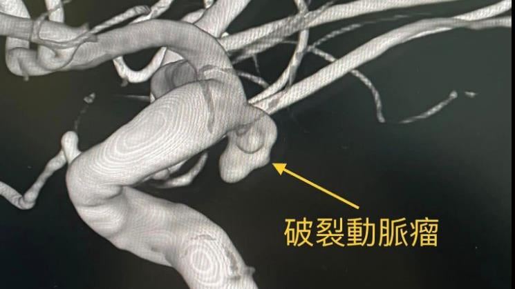 腦動脈瘤如不定時炸彈　醫籲做1健檢