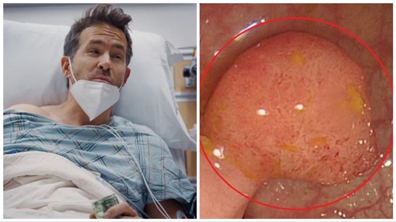高清無碼！這種大腸息肉癌變機率很高