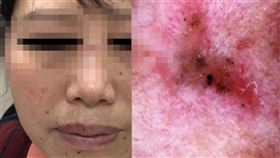 痣(圖/翻攝自微博)