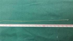 20歲女左側無力2年！常有「想抱人的衝動」　醫開顱拔出27cm寄生蟲