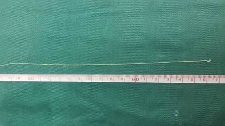 20歲女左側無力2年　開顱取27cm活蟲