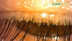 中國醫藥大學附設醫院眼科醫學中心主治醫師李宥伶醫師說；油性膚質、免疫力低下的人，容易因毛囊蠕形蟎蟲吞食人體皮膚細胞，造成毛囊腫大發炎，若刺激上皮增生及角質化、睫毛皮屑聚集，睫毛也容易脫落或稀疏。