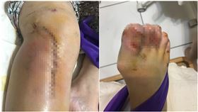 傷勢,台北,特斯拉,許凱皓,女外送員,違停,粉碎性骨折,開放性骨折（圖／翻攝畫面）