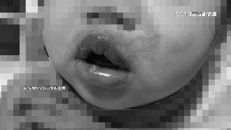 師餵70度高溫奶　1歲嬰二度燙傷成香腸嘴