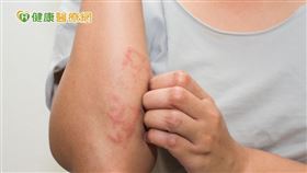 對抗異位性皮膚炎是的確是需要長期抗戰，於是邱品齊醫師呼籲，最好的方式就是從嬰幼兒期一發病，就要及早治療處理以阻斷發炎過程。