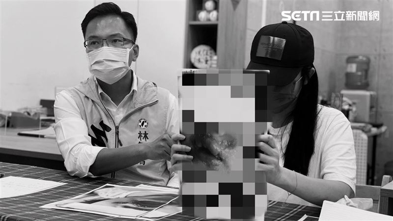 1歲童喝奶燙成香腸嘴　母挺孕肚現身淚崩