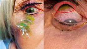 舊的不拔直接帶新的！老婦眼中堆23片隱形眼鏡 取出全部發綠