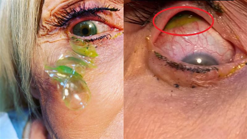 忘記摘又戴新的！婦眼睛取出23片發綠隱眼