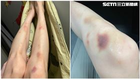 瘀青，跌倒，家暴，受傷，（示意圖／資料照）